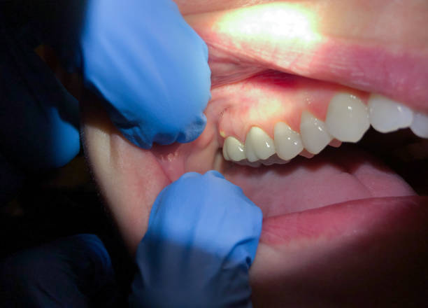 Best Emergency Treatment for Dental Infections or Abscesses in Landover Hills, MD